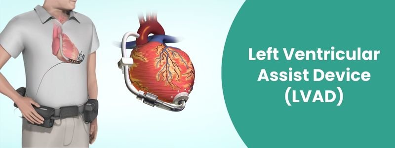 Left Ventricle Assist Device (LVAD) Cost in India | Mejocare