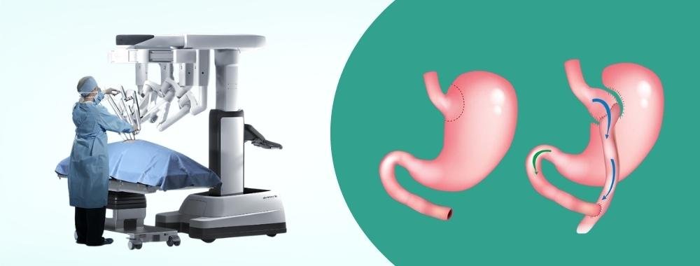 technologies used in india for gastric bypass surgery