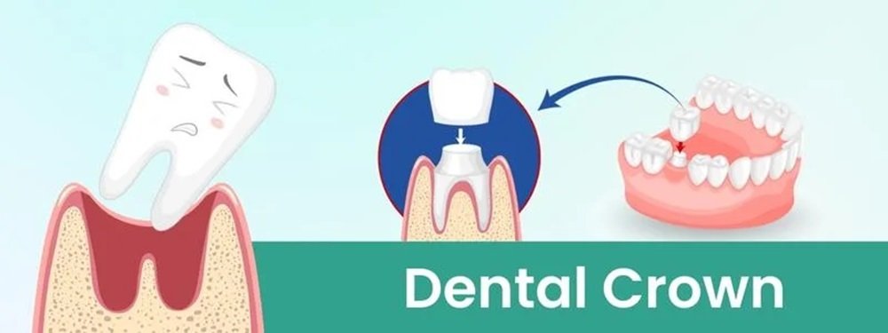 dental crown cost in india