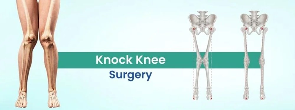 knock knee surgery cost in india