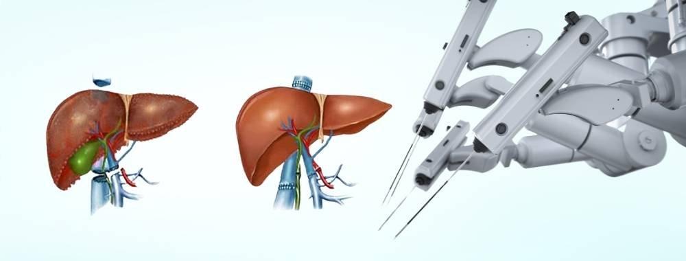  technology used in india for liver transplant surgery 