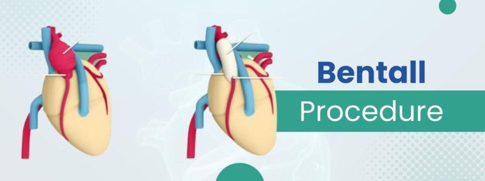 bentall procedure cost in india