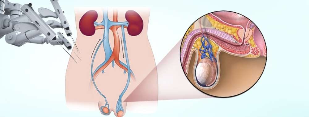 technologies used in india for varicocele embolization