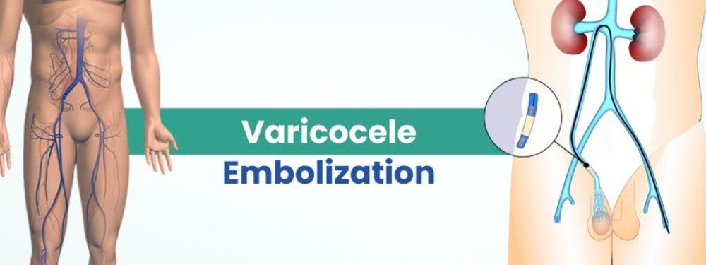 varicocele embolization cost in india