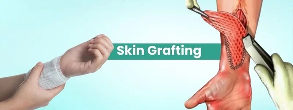 skin grafting cost in india