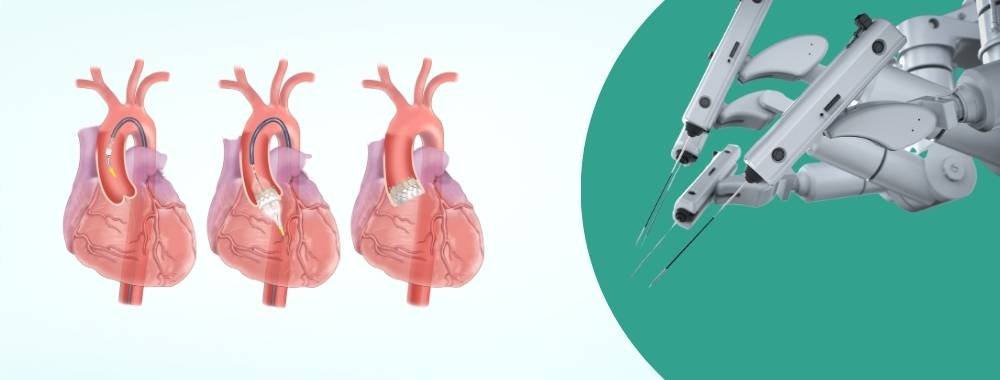 technologies used in india in transcatheter aortic valve replacement