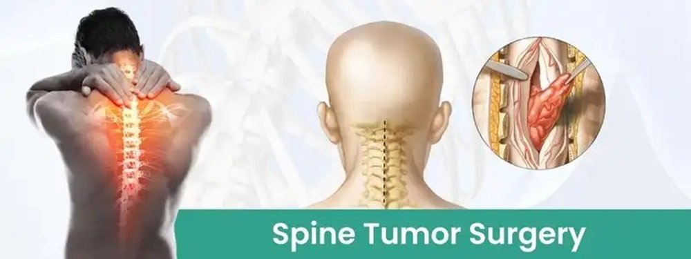 spine tumor surgery cost in india