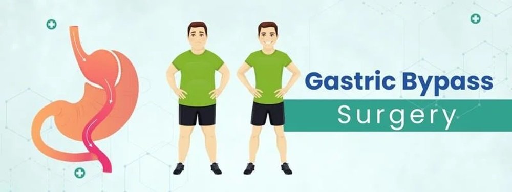 gastric bypass surgery cost in india