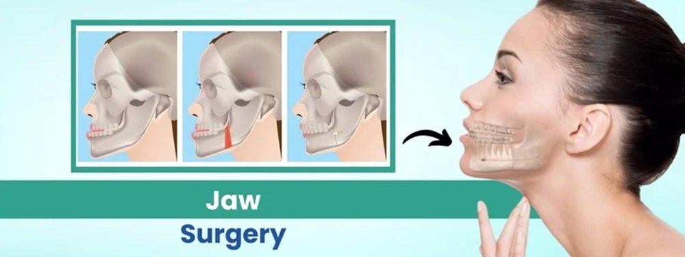 jaw surgery cost in india