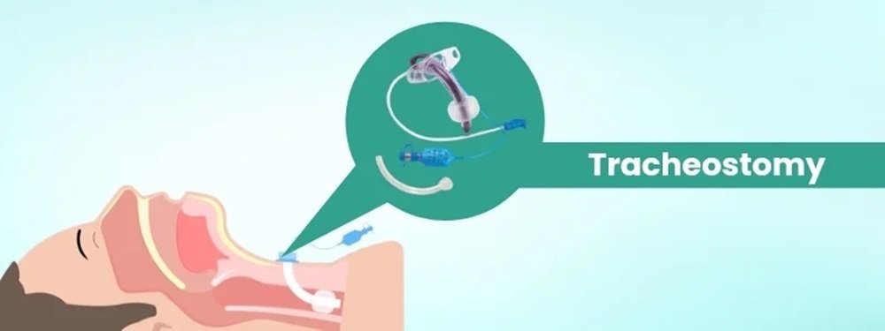 tracheostomy cost in india